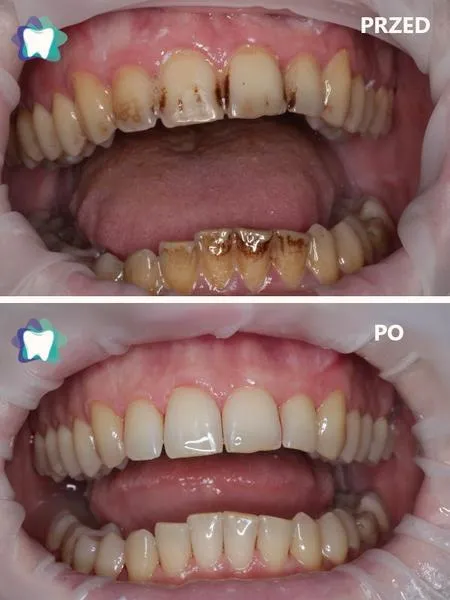 Usuwanie osadu z toalety